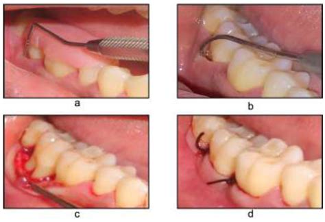 Open Flap Debridement A Pre Operative With Stent V Ppd B Hpd C