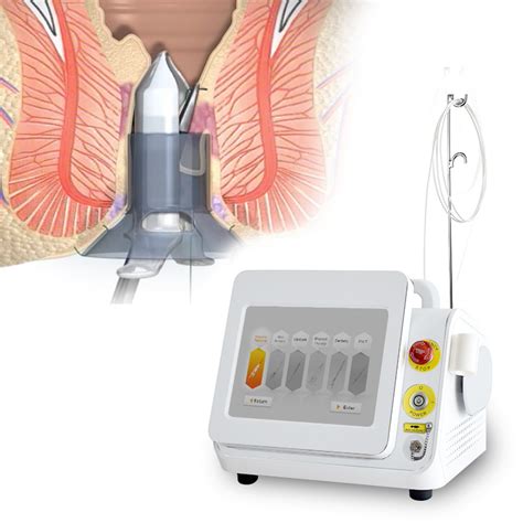 New Technology Laser Hemorrhoid Removal Machine For Hemorrhoid