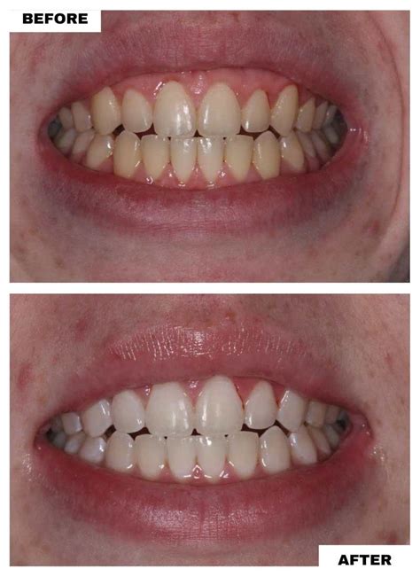 Cosmetic Dentistry Before and After: Invisalign, Zoom, Veneers - South ...