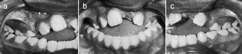 Pretreatment Intraoral Photographs Showing The Missing Left Maxillary