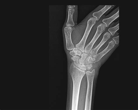 Ulnar Deviation X Ray