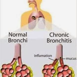 Is Bronchitis Contagious And Symptoms Information