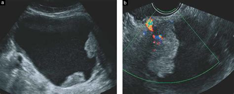 Ovarian Cancer Arising In Endometrioid Cysts Ultrasound Findings