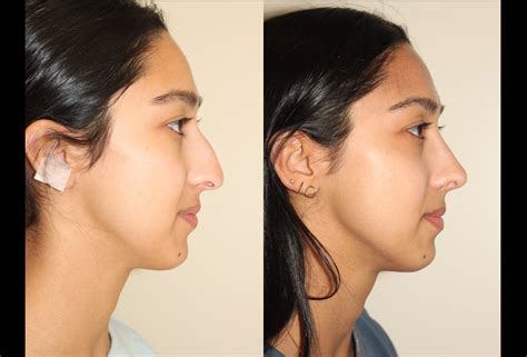 Rhinoplasty Dr Denton