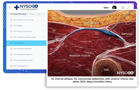 Ultrasound Guided Fascia Iliaca Nerve Block Nysora