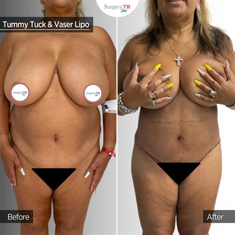 Tummy Tuck In Turkey Abdominoplasty SurgeryTR