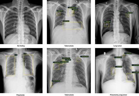 VinDr CXR The Largest Public Chest X Ray Dataset With Radiologist