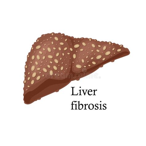 Fibrosis Of The Liver Stock Vector Illustration Of Liver 195719386