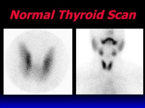 Nuclear Medicine Thyroid Procedurescan