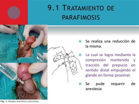 Fimosis Y Parafimosis