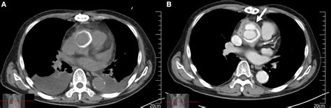 Figure 1 from A Case of Vascular Graft Infection Caused by Haemophilus ...