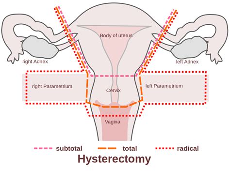 Cashless Hysterectomy Surgery by Laparoscopic Method | Mahapatra ...