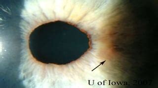 Ocular sarcoidosis | PPT