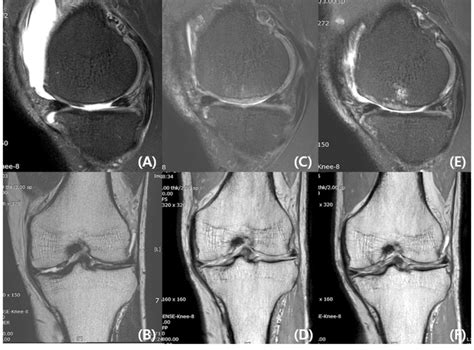 A Year Old Male Patient With Full Thickness Cartilage Defect On