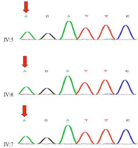 Sanger Sequence Chromatogram Of Crb1 Gene Of Three Blind Patients