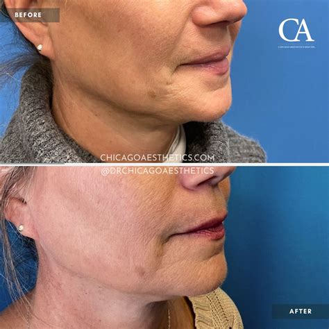 Sofwave Before After Photos Chicago Aesthetics MedSpa