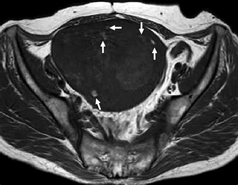 MRI Findings Of Uterine Lipoleiomyoma Correlated With Pathologic