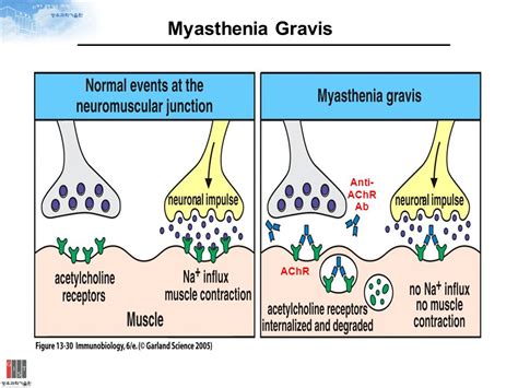 Myasthenia gravis and antibiotics use