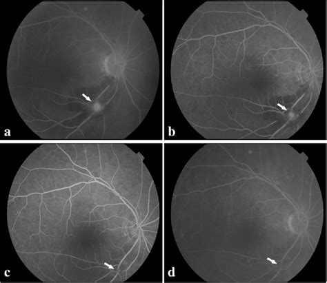 Multimodal Imaging Of The Affected Eye In Case A Fa Image At The