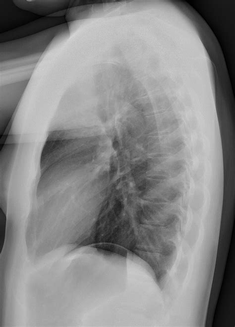 Chest X Ray Pneumonia Lateral