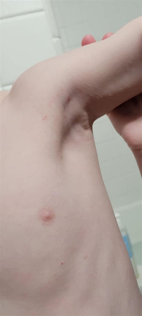 Itching and red bumps. : r/DermatologyQuestions