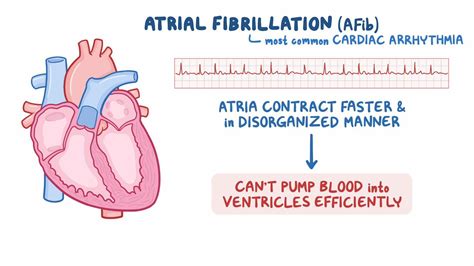 Arrhythmias - Atrial fibrillation (Afib): Nursing - Osmosis Video Library