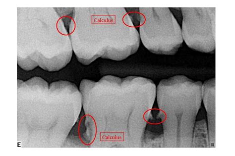 Tartar | Ask A Dentist