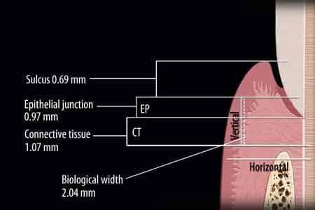 What is biological width in dentistry? | News | Dentagama