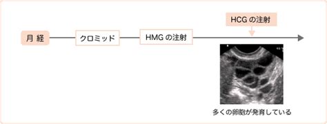 不妊治療の流れ 不妊治療 診療案内 よつばウィメンズクリニック