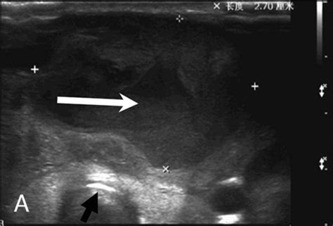 Figure 1 From The Utility Of Fistulography In The Diagnosis Of