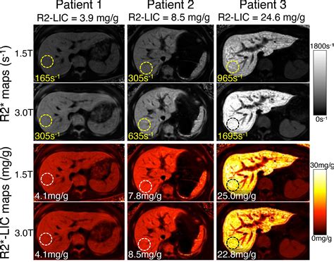 Quantification Of Liver Iron Overload With MRI Review And Guidelines