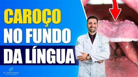 Língua Ferida O Que Pode Ser - Caroço na língua! O que pode ser? | Remédios caseiros, Lingua, Ferida ...