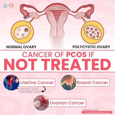 Pcos What Happen If Left Untreated