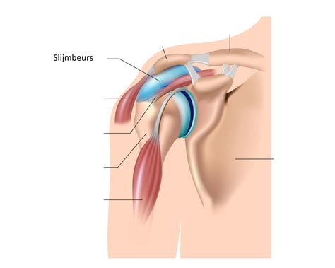 Slijmbeursontsteking In De Schouder