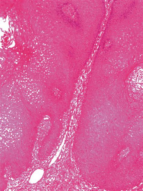 Cutaneous Verrucous Carcinoma Infiltrative Tumoral Islands Of Squamous