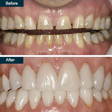 Porcelain Veneers - Cosmetic Dental Veneers in Yonkers, NY