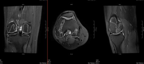 MRI Knee – bone infarcts? – OCAD