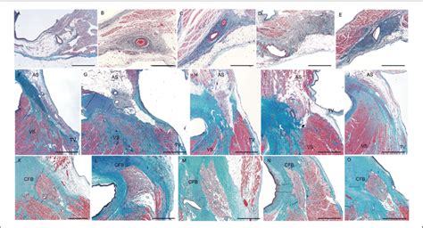 Histological appearance of the sinoatrial node in sinus node ...