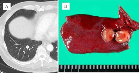 Ibima Publishing Synchronous Bilateral Peripheral Typical Pulmonary Carcinoid Tumors Report