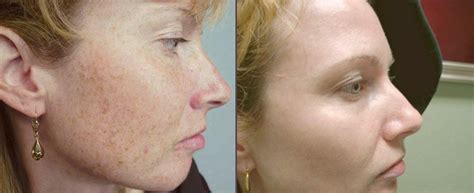 Face Pigmentation Treatment At Home Doctor Heck