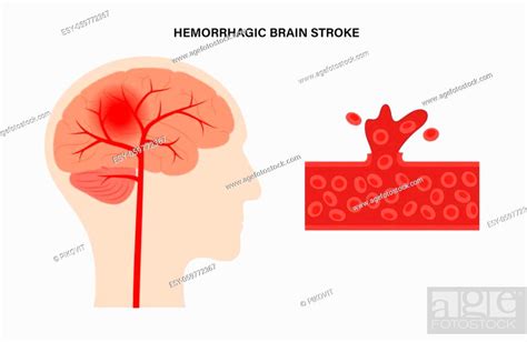 Hemorrhagic Brain Stroke Concept Apoplexy Cerebral Hemorrhage Headache Problem Stock Vector