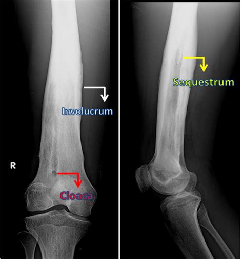 Bony Sequestrum Radiology Reference Article