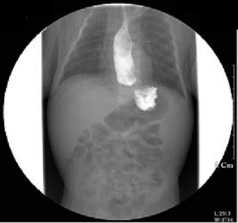 Figure 1 From A Case Of Esophagitis And P Erinatal Cytomegalovirus