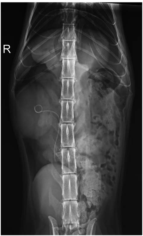 Modified Endoluminal Ureteral Stenting For The Management Of Proximal