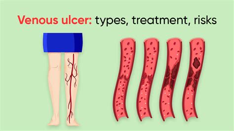 Venous Ulcer Types Treatment Risks Laser Vein Clinic