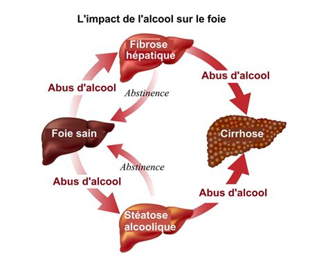 Maladies Alcooliques Du Foie Liste Et Symptômes Dalerte