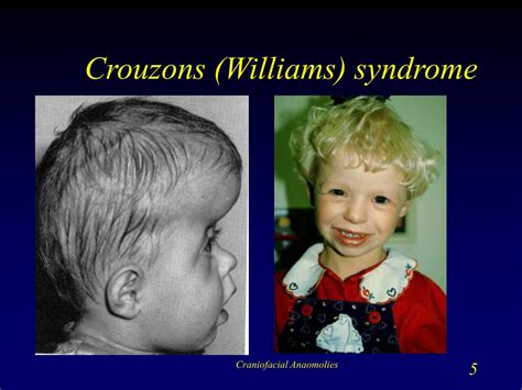 Ppt Craniofacial Disorders Powerpoint Presentation Free Download