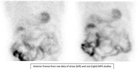 Large Sliding Hiatus Hernia Incidental Finding In Myocardial Perfusion