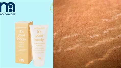 Cek Pilihan Salep Stretch Mark Terbaik Yang Aman Dan Mudah Ditemukan