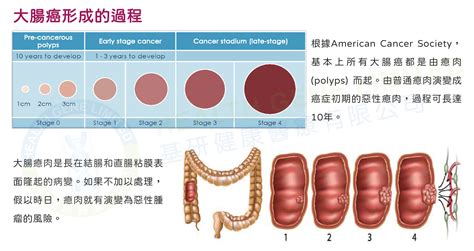 及早發現 大腸癌 早期大腸癌篩查 Health Gene Limited